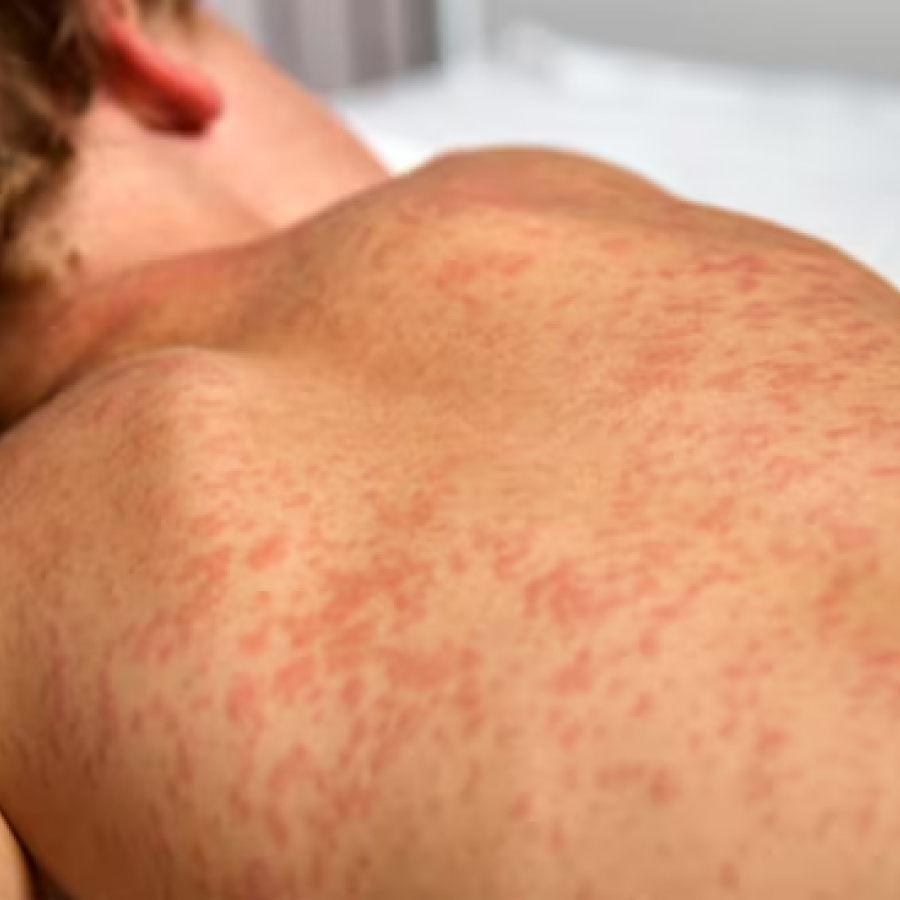 Measles